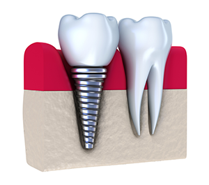 Dental Implants Baltimore North Baltimore MD